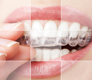 隐形矫牙隐形矫牙_无锡尚美口腔美容中心